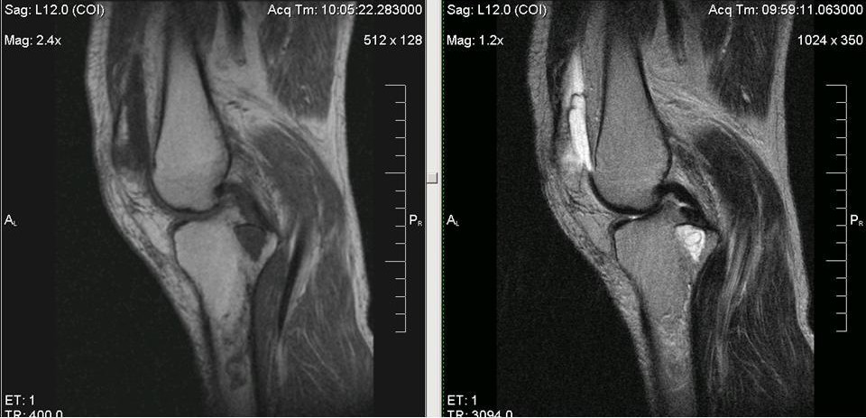 Мр картина синовита коленного сустава