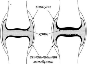 Субхондральный склероз суставной поверхности большеберцовой кости
