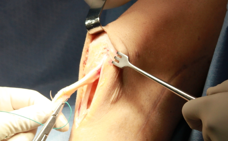 Повреждение связки надколенника