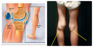 Киста коленного сустава лечение детей thumbnail