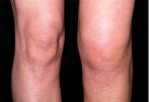 Доа коленного сустава 2 степени лечение