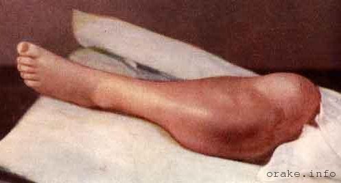 Саркома На Ноге Фото