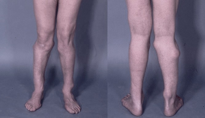 Костный экзостоз коленного сустава