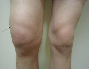 Повреждение пкс коленного сустава мкб 10 код