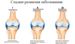 Остеоартроз обоих коленных суставов код по мкб 10