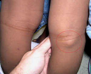 Грыжа беккера коленного сустава лечение thumbnail