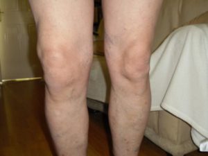 Полиартрит коленных суставов код мкб 10