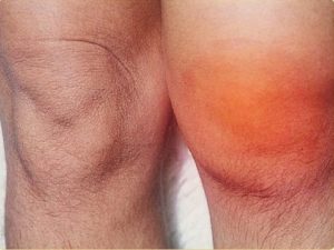 Изображение - Артропатия коленного сустава мкб 10 artroskopija-meniska_04-300x225