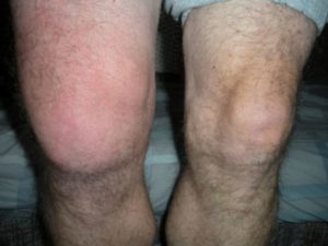 жировик на суставе колена