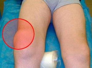 Изображение - Коллатеральные связки коленного сустава лечение bursit_kolennogo_sustava-2-1-300x220