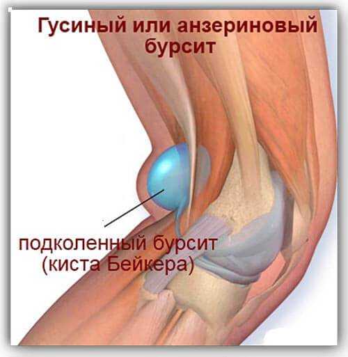 Синдром гусиной лапки коленного сустава симптомы причины диагностика и лечение