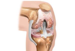 Что такое остеофиты коленного сустава разрастание костной ткани и как от него избавиться