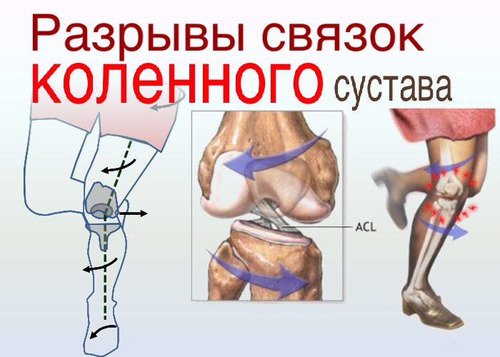 Повреждение коленной связки симптомы. Разрыв связок симптомы сустава. Перерастяжение связок коленного сустава. Диагностика повреждений боковых связок коленного сустава. Разрыв связок коленного сустава.