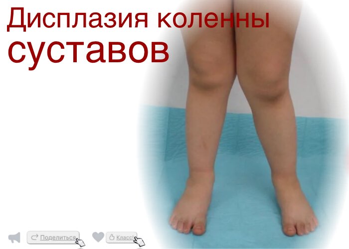 Дисплазия коленного сустава народными средствами сустав что это