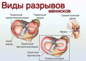 Разновидности разрывов мениска коленного сустава