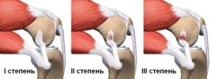 Повреждение пкс коленного сустава мкб 10 код thumbnail