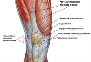 Теносиновит полуперепончатой мышцы коленного сустава лечение