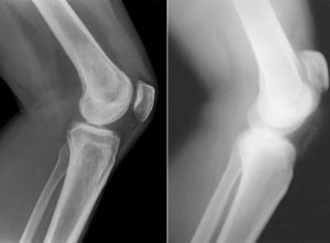 Изображение - Контрактура коленного сустава операция koleno-3-300x221