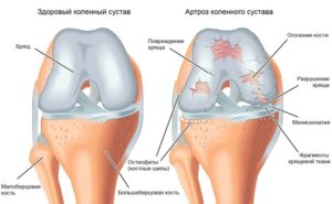Что такое остеофиты коленного сустава разрастание костной ткани и как от него избавиться