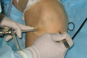 Артроскопия мениска колена