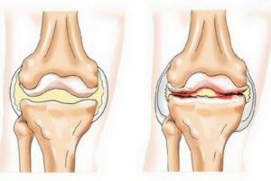 Что такое пателлофеморальный болевой синдром коленных суставов
