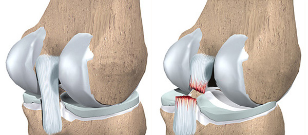 Повреждение передней крестообразной связки коленного сустава фото