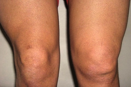 Ревматизм коленного сустава: симптомы и лечение