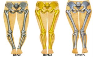 Варусная деформация коленных суставов лечение