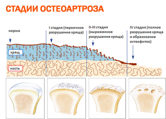 Остеоартроз коленного сустава - лечение 1,2 и 3 стадии