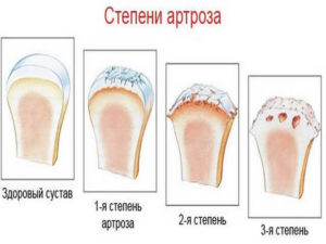 Остеоартроз коленного сустава - лечение 1,2 и 3 стадии