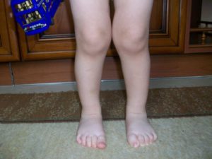Варусная деформация коленных суставов у взрослых и детей: лечение