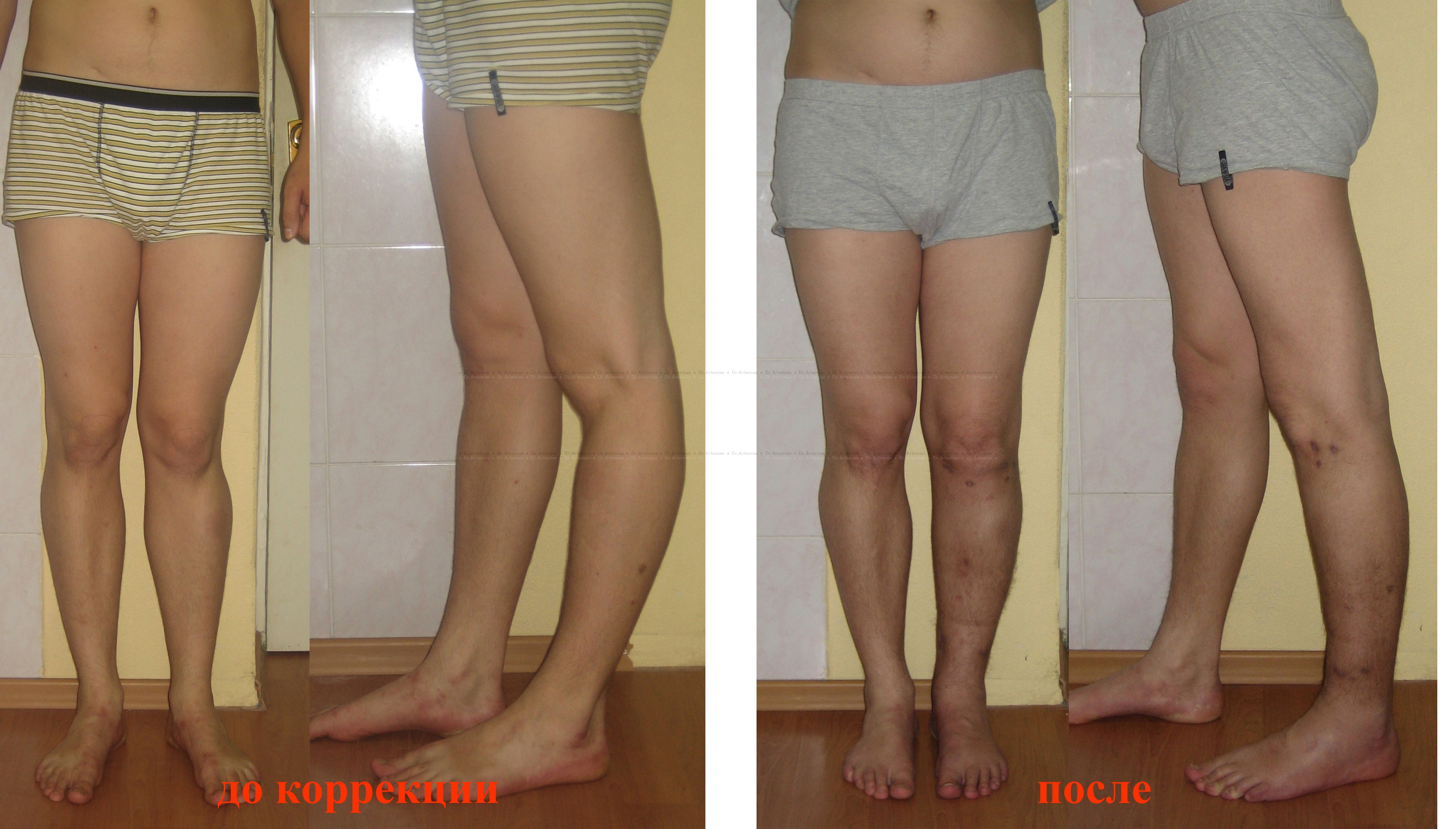 Варусная деформация коленных суставов