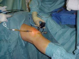 Артроскопия коленного мениска