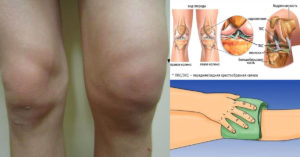 Воспаление мениска коленного сустава
