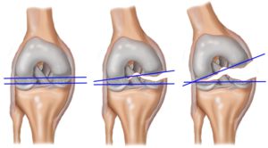 Повреждение коленного мениска