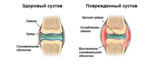 Поврежденный коленный сустав