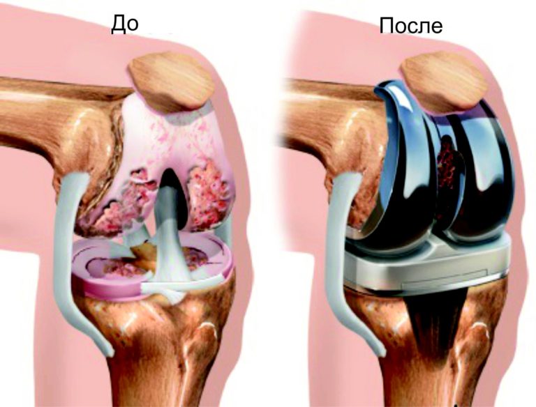Лечение коленного сустава витафоном схема лечения