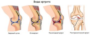 Разновидности коленного артрита