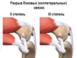 Разрыв боковых связок колена