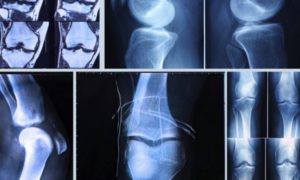 Рентгенографическое исследование колена