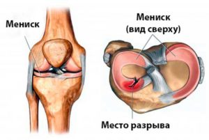 Мениск коленного сустава - повреждения и разрывы