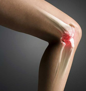 Трещина коленного сустава лечение в домашних