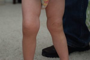 У ребенка опухло колено не артрит