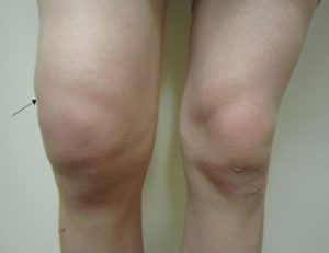Блокировка коленного сустава при артрозе