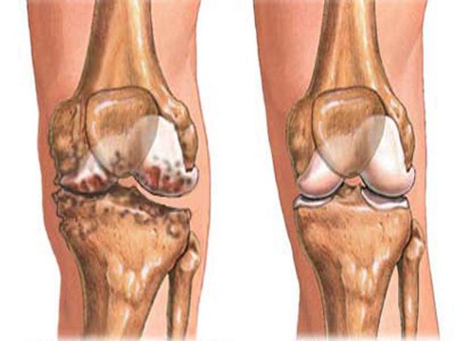 Гонартроз коленного сустава 3 степени что это такое и лечение фото