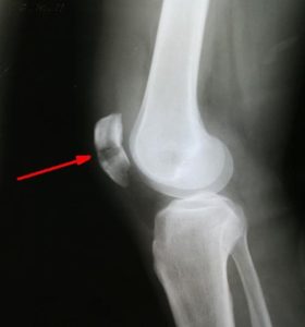 Лечение трещин в коленном суставе