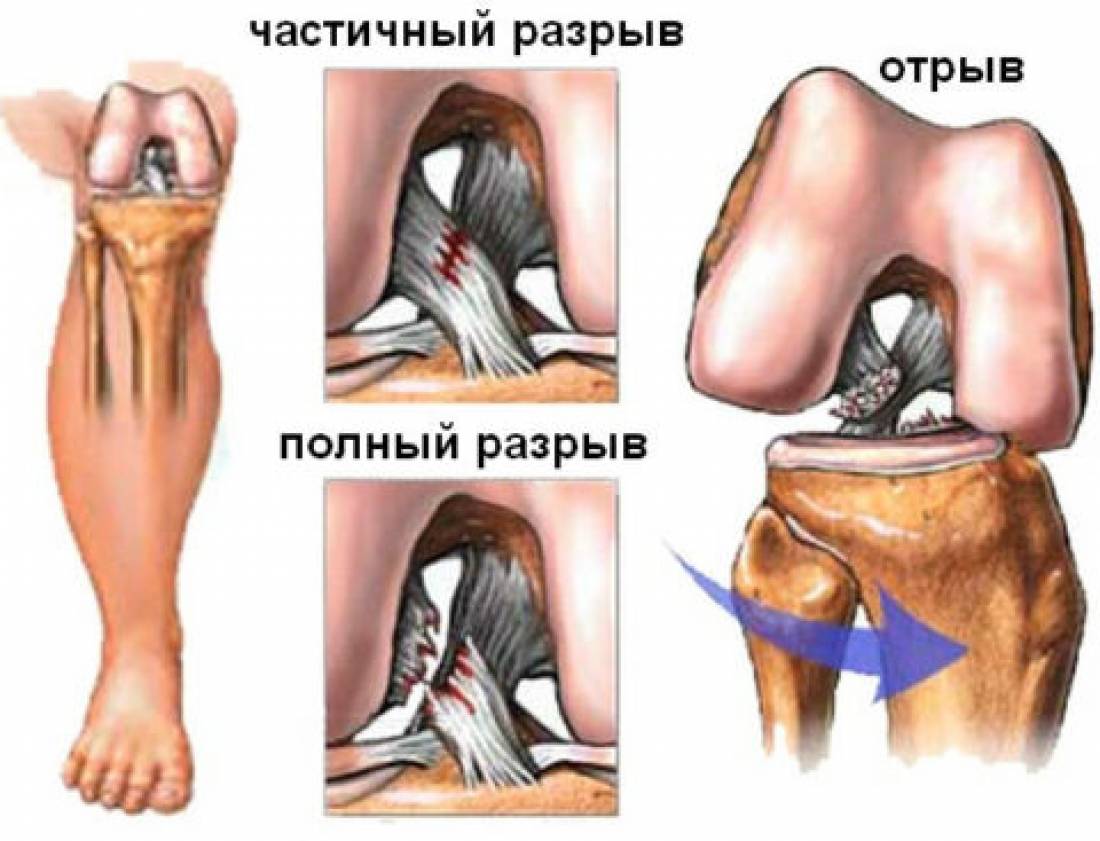 Операция колено пкс. Классификация разрывов крестообразной связки. Отрыв крестообразной связки колена. Повреждение ПКС коленного сустава. Передняя крестообразная связка коленного сустава разрыв.