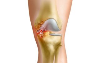 Гнойный артроз коленного сустава лечение