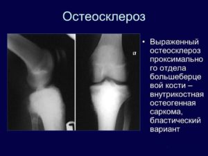 Остеосклероз коленных суставов лечение