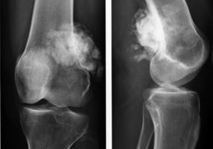 Остеома коленного сустава симптомы и лечение